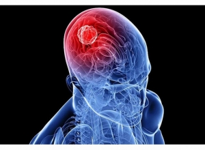 Những Dấu Hiệu Và Triệu Chứng Cảnh Báo Bệnh U Não